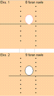 Alle spener som er foran eller på denne streken skal telles med som antall spener foran navle. Se figur 1 og 2. Foran navle Figur 1: To eksempler på telling av spener foran navle.