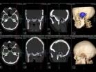 Teknisk utvikling CT på SUS HRCT Standard CT Thorax Volumenopptak Fra 1989 Sequens CT Døde 2000 Fra 1996 Spiral CT Døde: 2008 Fra 2004 MDCT (16 slice) Døde i 2012 Fra 2008 MDCT ( 128, 2 fokus)