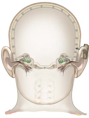 Mekanisk eller kombinert hørselstap Pasienter med mekanisk hørselstap som fremdeles kan ha nytte av at lyden blir forsterket, kan være kandidater til en benforankret løsning.