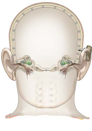 Ensidig døvhet (SSD): Unilateralt sensorinevralt hørselstap Pasienter som lider av betydelig sensorinevralt hørselstap på ett øre og normal hørsel på det andre, kan være egnede kandidater til et