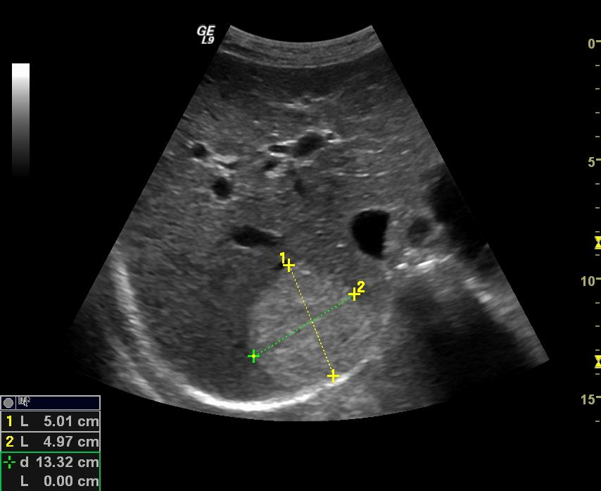 Vanlig sonopatolgi i lever, galleblære og pancreas Vanlig sonopatologi i lever Levercyster Ultrasonografi er meget nøyaktig til å påvise levercyster og særlig ved små cyster er ultralyd bedre enn CT.