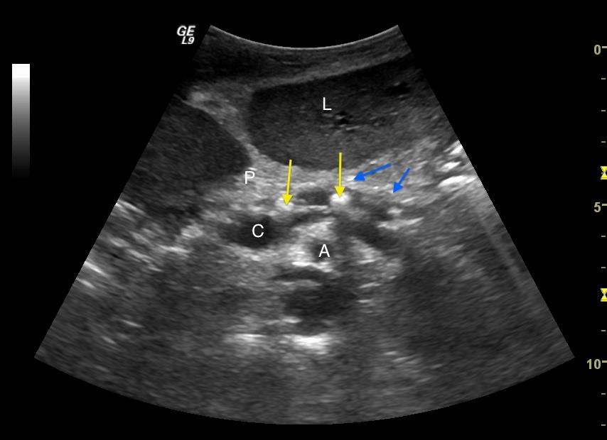 pseudocyster og absesser. Ved ultralyd ser man ofte store hypoekkogene områder i og ved pancreas som uttrykk for ødem og inflammasjon (figur 19).