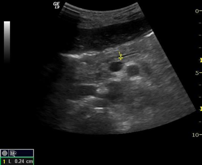 Pankreas-2 M P Ductus pancreaticus