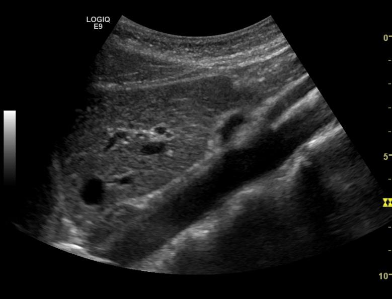 Stasjon 1 og 2 Aorta Glatt vegg Diameter<3cm V.