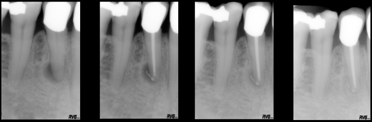 Figur 1: Periapikale bilder av en tann før rotfylling, etter rotfylling, etter 3 måneder og etter 12 måneder, hvor man