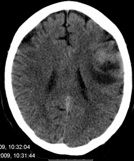 Dette ble oppfattet som epilepsi. CT viste tumor temporofrontalt venstre side, operert med reseksjon og histologisk bekreftet glioblastoma multiforme (Gliom grad IV). Pas.