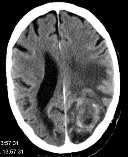 CT viste en lesjon frontalt venstre side ut mot overflaten, histologisk bekreftet å være en godartet tumor - meningeom. Pas.