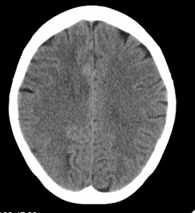 CT viser en diskret lesjon frontalt høyre side (mørkere område), histologisk bekreftet oligoastrocytom grad II. Pas.