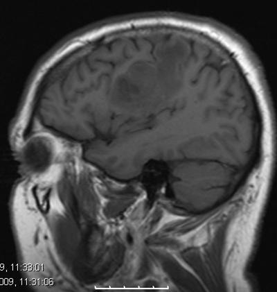 Man ser tydelig at cerebrospinalvæsken er hvit på T2 (se i ventriklene og rundt
