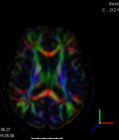 To diffusjonstensor kart av Pas.C. Selv om det er vanskelig å se på disse bildet skal det være mulig å følge viktige nervebaner for å f.eks. se om tumor avbryter dem. Fargene viser retningen (x-y-z).