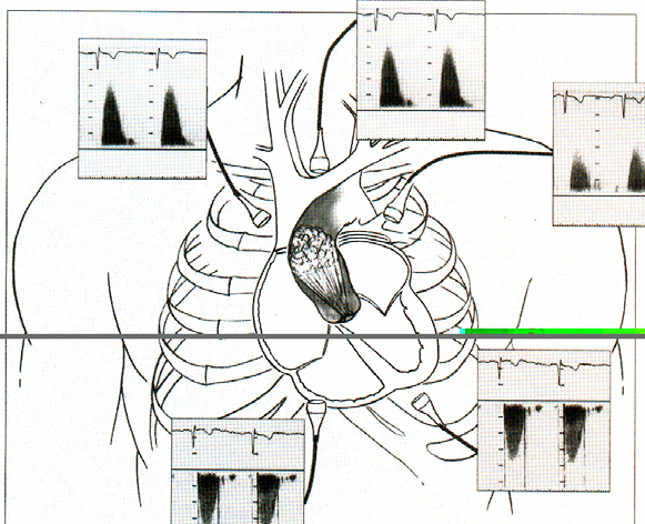 - estimering av TG med transtorakal Doppler For stor vinkel mellom ultralyd og stenosejet er en vanlig