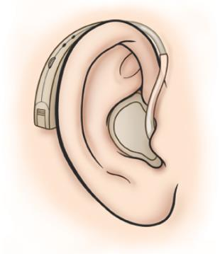 Teleslynge-programmet må noen ganger tilpasses For en del år siden var alle høreapparater utstyrt med støpt propp, noe som betyr at all lyden går via høreapparatet.