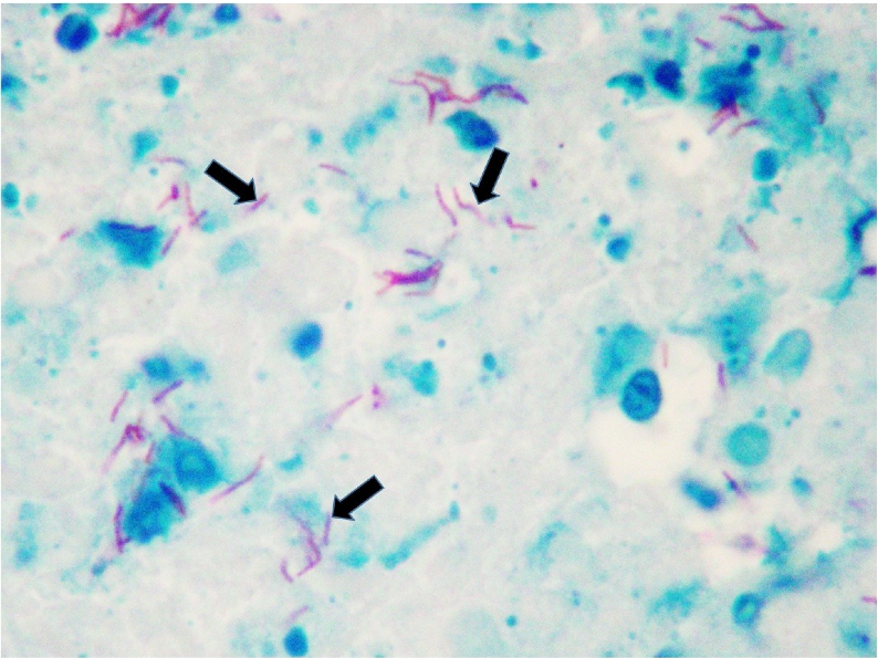 DIAGNOSTIKK Direkte mikroskopi; ser etter syrefaste staver. Krever 5-10 000 bakterier/ml (luftveisprøver) PCR; krever 10 bakterier/ml.