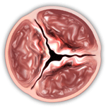 Aortastenose Oftest en degenerativ sykdom som fører til forsnevring av aortaklaffen.