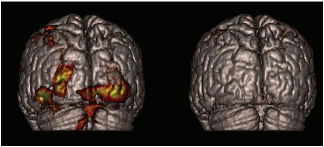 Rewiring of neural circuits to serve other functions Activation of visual cortex in a