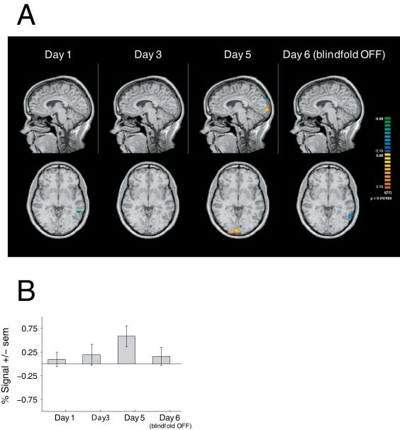 visual deprivation in seeing individuals leads to activation of visual cortex when