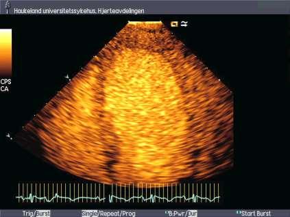 Stress-indusert Kardiomyopati Takotsubo Kardiomyopati The broken heart syndrome Apical ballooning syndrome