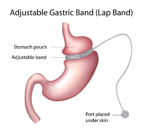 Figur 4 Justerbart gastrisk bånd (fra Shuttersstock) I Norge i dag gjøres fedmekirurgi stort sett ved laparoskopisk kirurgi (kikkehullskirurgi), og de vanligste prosedyrene er gastrisk bypass,