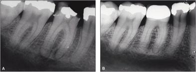 Figur 1. A: Røntgenbildet viser apikale forandringer mesialt og distalt på tann 46 hos en 32 år gammel kvinne.