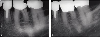 Figur 4. A: Røntgen viser tann 36 med avkortet distal rot. B: Fire år etter er situasjonen uendret (bildet tatt med en noe ulik stråleretning).