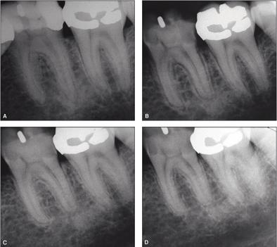 Ingen pulpaeksponering kunne påvises etter at tannen var ekskavert ren (Figur 5A). Pasienten ble orientert om alternative behandlinger og var villig til å avvente situasjonen.