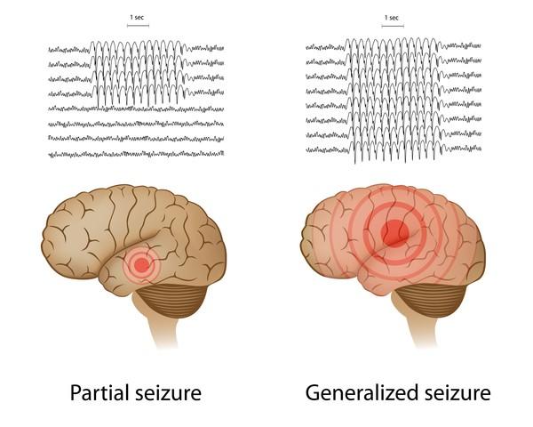 Generaliserte epilepsianfall GTK (generalisert tonisk klonisk anfall starter med en tilstivning og deretter kramper) Absencer (fjernheter med spesielt