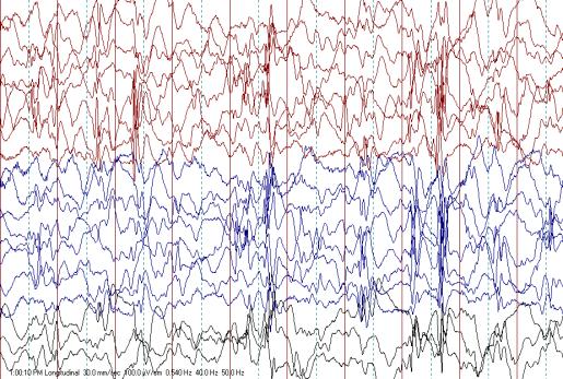 være målet Hos barn med behandlingsresistent epilepsi må man tilstrebe en likevekt mellom best mulig anfallskontroll minst