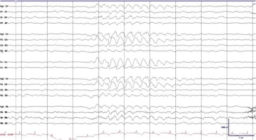 EEG: Angelmans syndrom EEG: Angelmans syndrom Fig. 1. Representative EEG showing anterior predominant intermittent rhythmic delta activity. Vendrame, M et al.