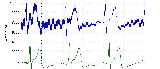 Støyfiltrering på EKG-signal Matlab: Aase.