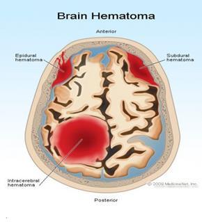 Alvorlig traumatisk hjerneskade (TBI)