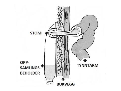 HVA ER EN ILEOSTOMI Når endetarmen og tykktarmen fjernes konstrueres en ny tarmåpning (stomi) ved at nederste del av tynntarmen (ileum) tas ut gjennom bukveggen og sys fast til huden.