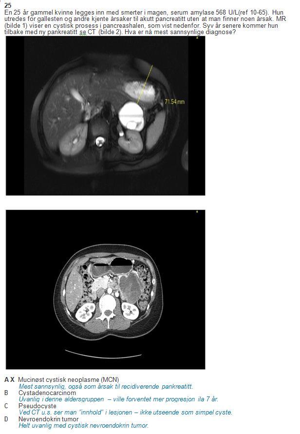 Spørsmål 25 (gastrokirurgi) Spørsmålet ble vurdert som vanskelig, og