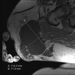 MR viste en ca 11 cm i diameter