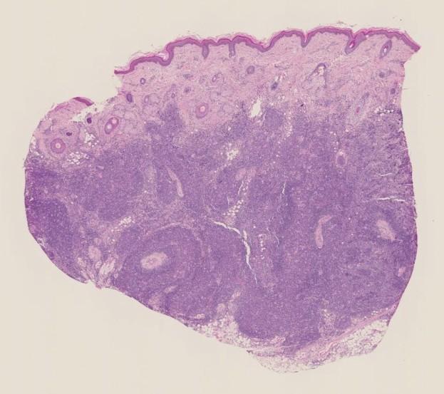 KASUS 7 Diagnose: Lymfocytoma cutis sekundært til borreliose (påvist serologisk) Nodulært lymfoid
