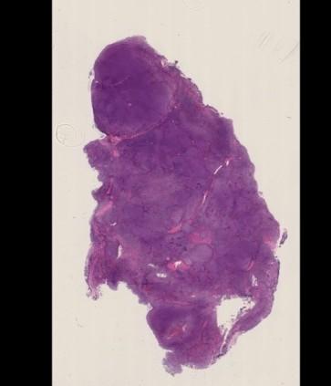 KASUS 6: Diagnoseforslag Marginalsonelymfom: 14 Småcellet lymfocyttært