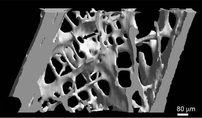 Figur 12 Eksempel på mikro-ct bilde av beinprøve fra en pasient med normal beinbygning. Figuren er hentet fra litteraturen og er lett modifisert (Chappard et al. 2010).