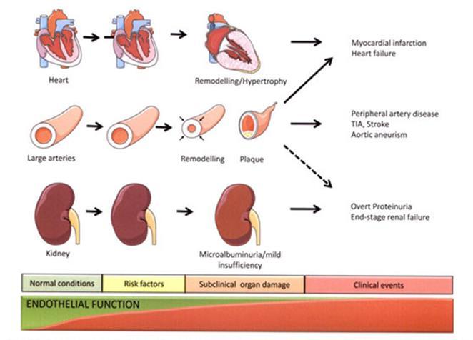 Proteinuria - økt hjerte/kar-sykdom og
