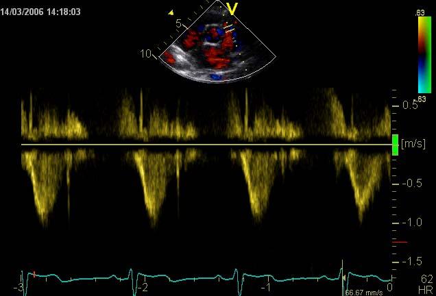 PS SAX Doppler RVOT Δt