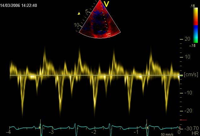 VevsDoppler,PW S