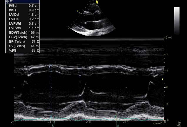 HV IVS M-mode mål Venstre ventrikkel IVSd LVIDd PWd