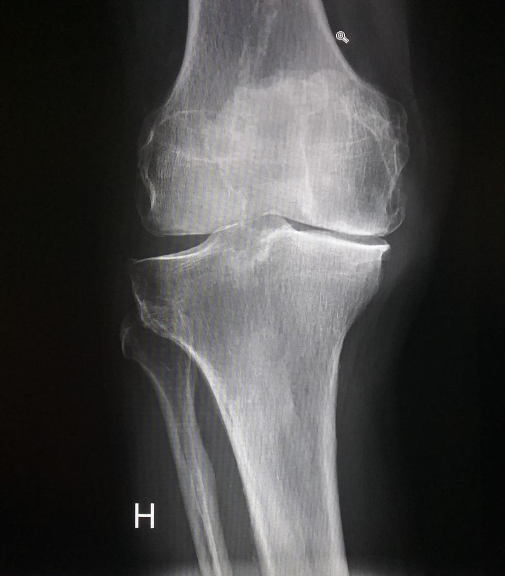 Avansert medial artrose. Redusert spaltevidde.