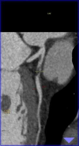 QCA: 90% stenose