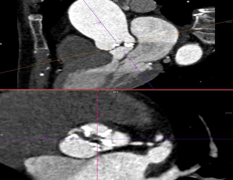 Forkalket bicuspid aortaklaff - dilatert