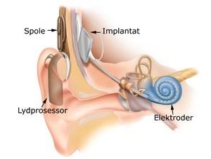 Illustrasjonsbilde av ett cochleaimplantat. Bilde hentet fra www.medisan.no (16/3-2015) Den innopererte delen implanteres i cochlea (sneglehuset).