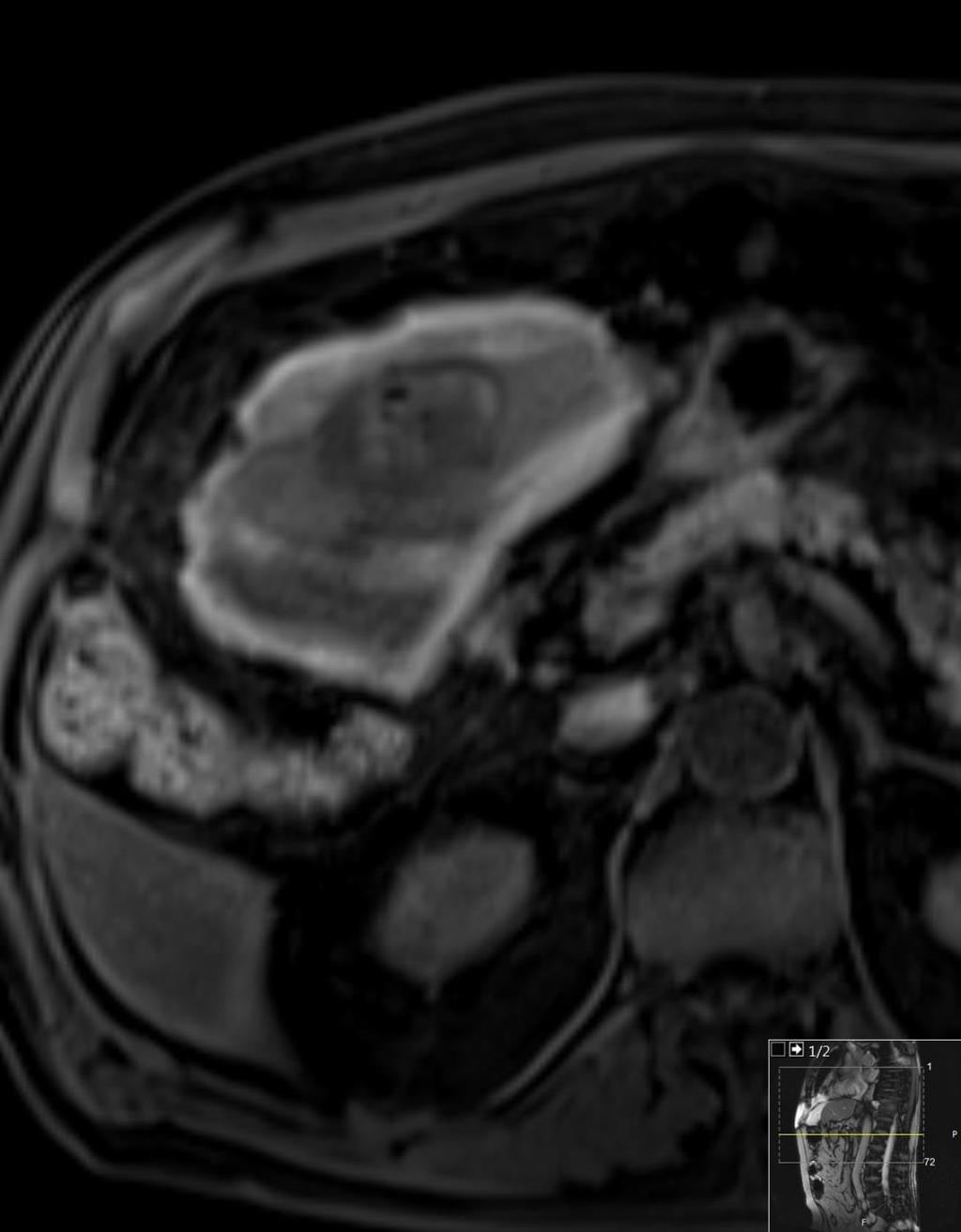 MR lever en uke etter embolisering/coiling: «Vellykket embolisert / coilet hypervasculær lesjon i