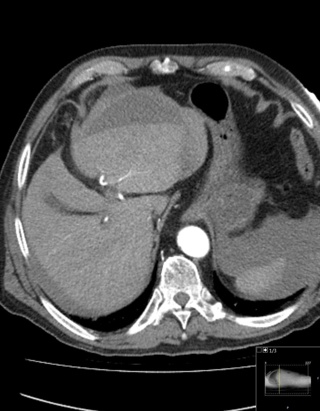 CT arteriefase: Mye blod fritt i buken, mest omkring lever. Pågående blødning med rikelig kontrastekstravasering i løpet av undersøkelsen.