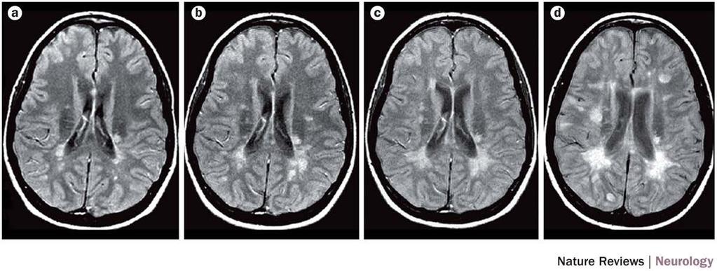 Serial MRI in a patient with relapsing remitting multiple sclerosis Wattjes, M. P. et al.