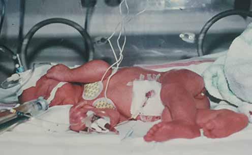 Min historie: Født prematurt og livet etterpå Mine minner som liten i forhold til det å være født prematurt, er mange. Både på godt og vondt.