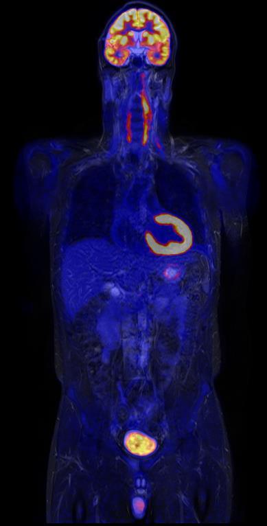 PET/CT ved kardiovaskulære infeksjoner Håkon Johansen konstituert overlege Avdeling for