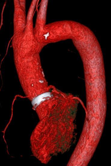 Mekanisk aortaklaff og rørgraft Implantert mekanisk aortaklaff samt conduitgraft i ascendens 2004